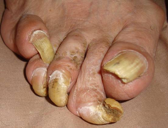 Claw-like nail case study